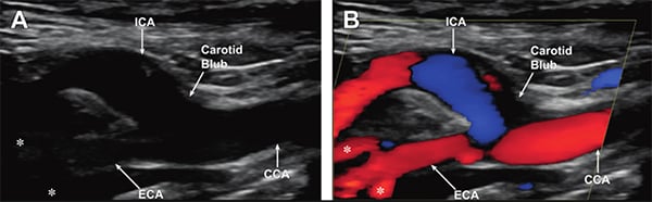 Ilustracja przedstawiająca obraz w skali szarości (A) i kolorowy obraz dopplerowski (B)